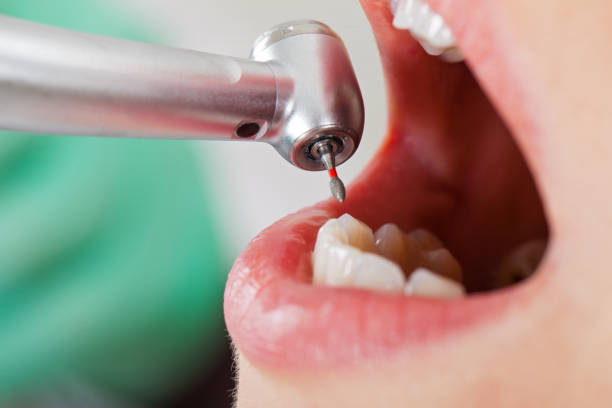 Best Emergency Dentist for Lost Fillings or Crowns in Bronx, NY